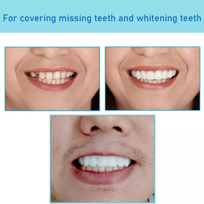 Instant Dental Veneer – Perfect Smile in Seconds