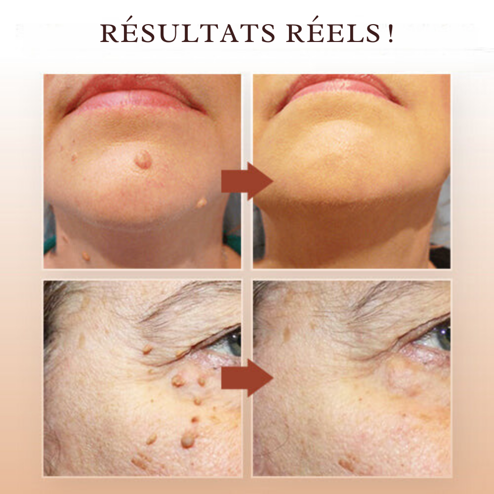 Natural Skin Tag and Wart Remover – Safe, Fast, and Effective Treatment