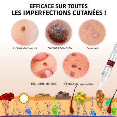 Natural Skin Tag and Wart Remover – Safe, Fast, and Effective Treatment
