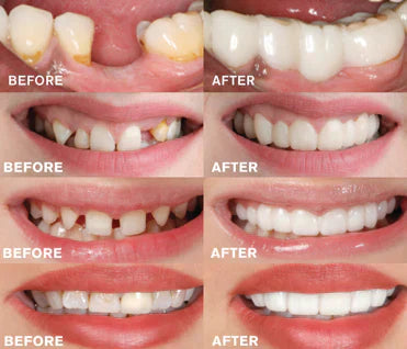 BrightDent SnapFit – Instant White Smile, Effortlessly